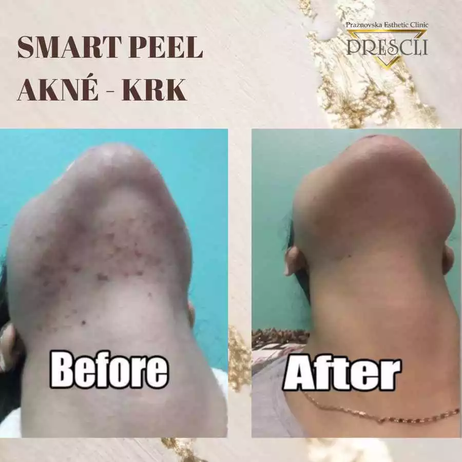 Pred a po Smart Peel – redukcia akné krku